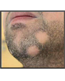 Alopecia Barbae Uk Hair Consultants